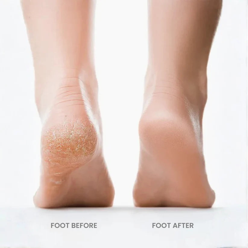 Velnuva Foot Grinder
